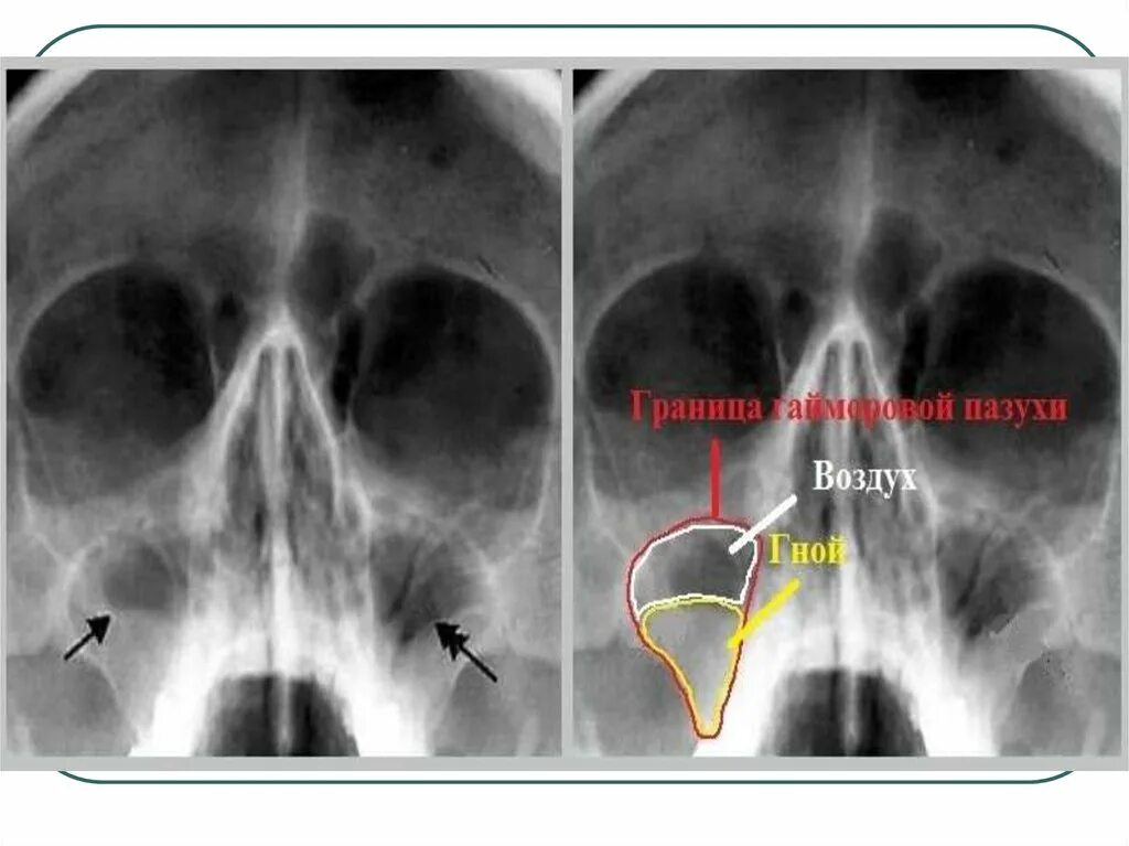 Пристеночный отек слизистой. Верхнечелюстной синусит рентген. Рентген гайморовых пазух. Рентген пазух носа гайморит. Рентген пазух носа гайморит снимки.