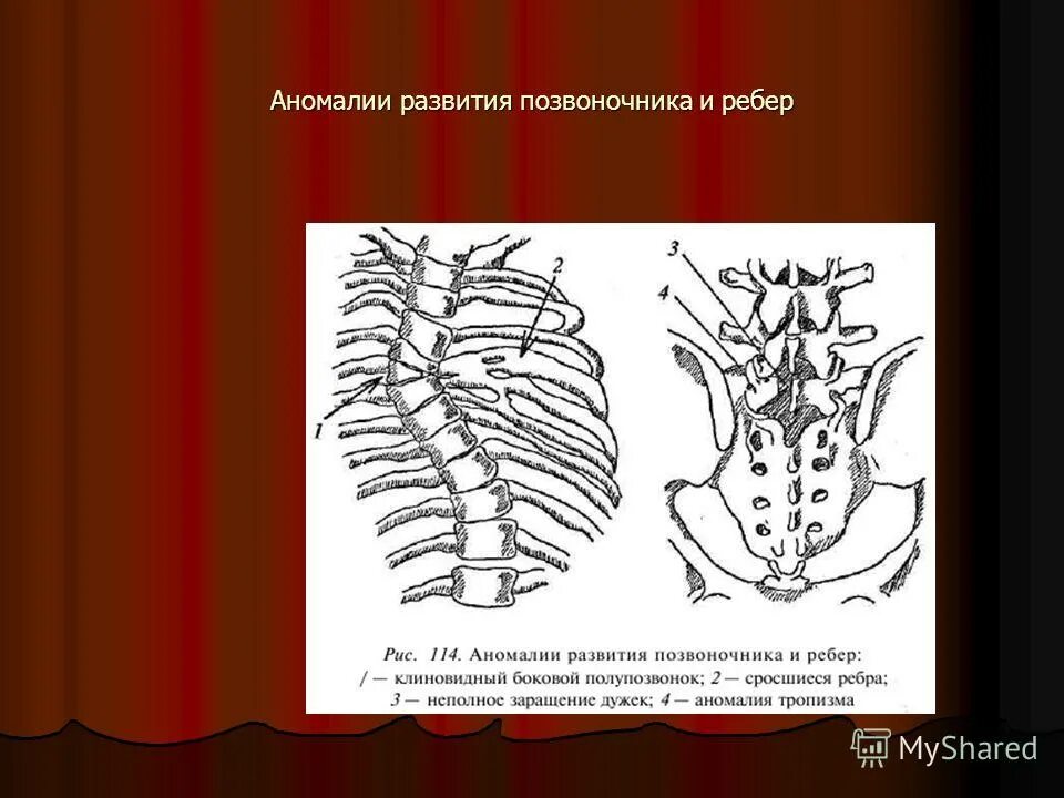 Аномалии развития позвоночника. Аномалии развития ребер. Аномалии развития ребер и грудины. Лопатообразное расширение ребра.