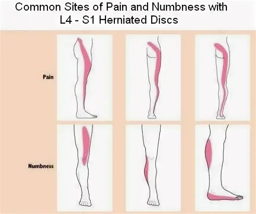 Радикулопатия l5 s1. Радикулопатия s1 корешка. Радикулопатия корешка l5 это. Радикулопатия s1.