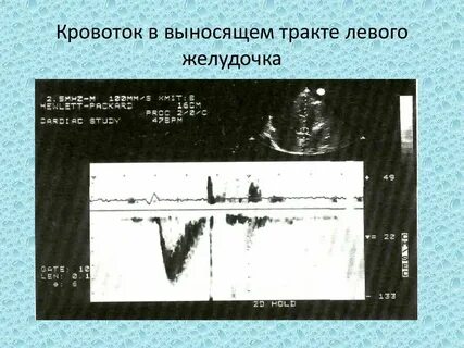 Левый выносить