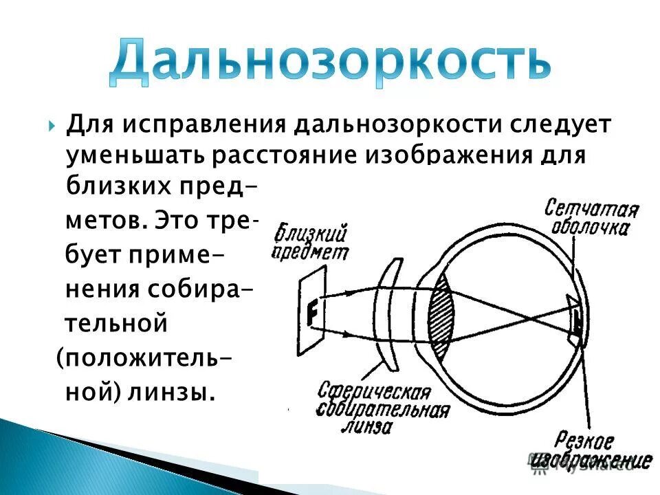 Причины возникновения дальнозоркости