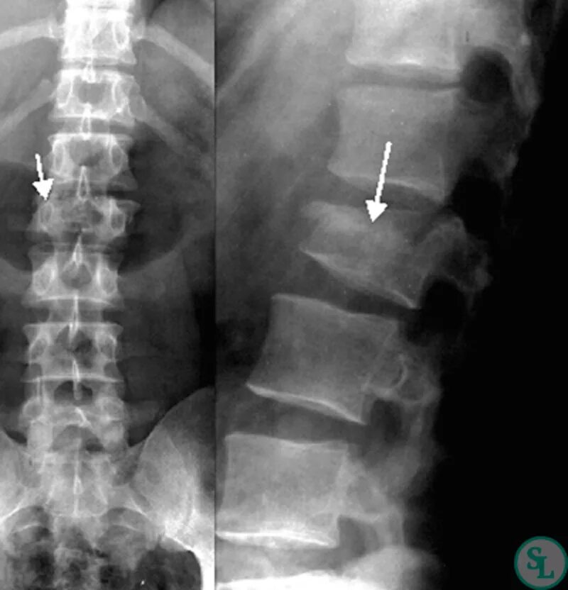Травма поясничного отдела позвоночника. Компрессионный перелом позвонка рентген. Компрессионный перелом позвоночника рентген. Переломы позвонков рентген. Компрессионно-оскольчатый перелом позвонка рентген.