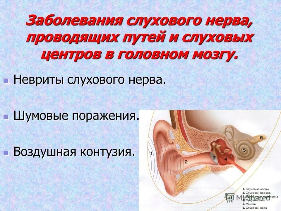 Поражение слухового нерва. Заболевания слухового нерва. Слуховой нерв симптомы поражения. Путь слухового нерва. Заболевания слухового нерва проводящих путей и слуховых центров.