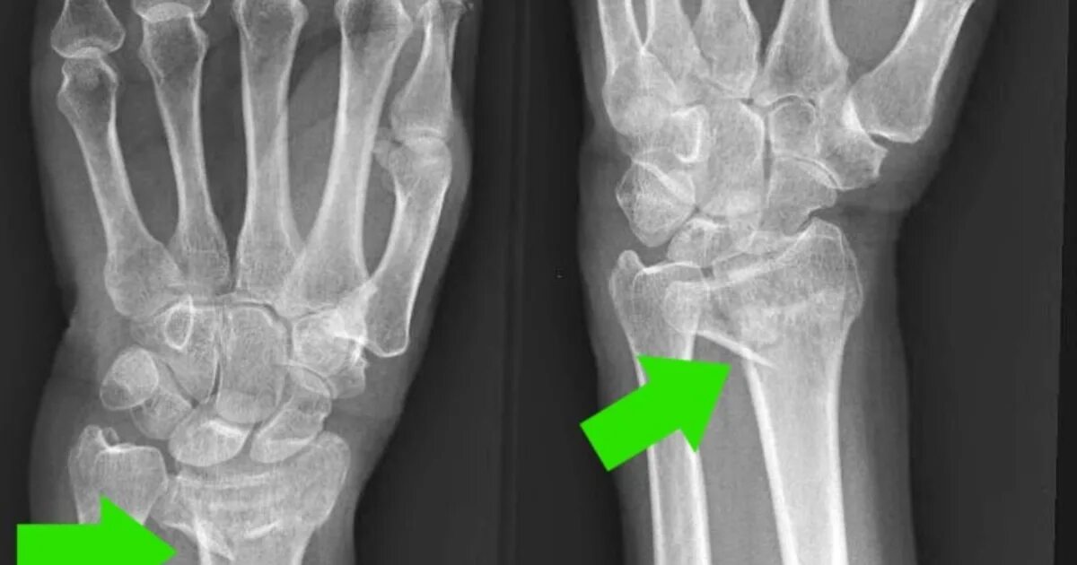 Radius fracture