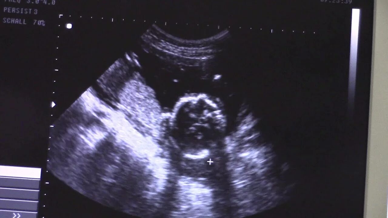 Фото мальчика 12 недель. УЗИ 18 недель беременности мальчик. УЗИ пол девочка в 18 недель беременности. УЗИ 18 недель беременности УЗИ девочки.