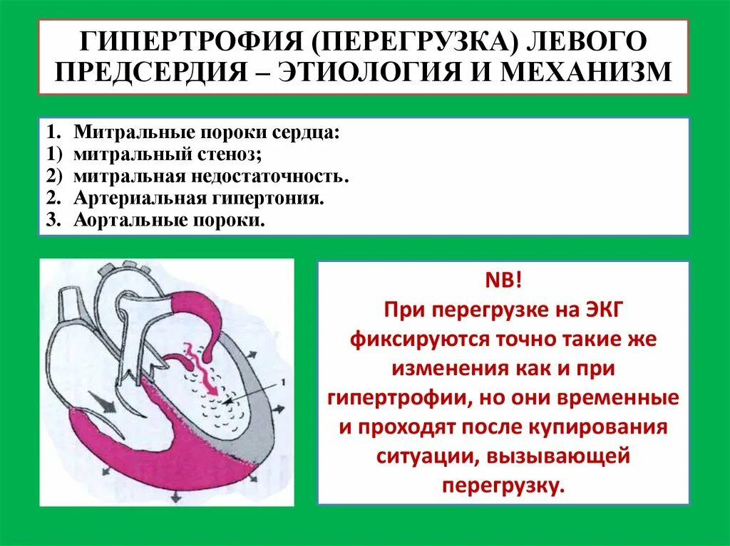 Гипертрофия миокарда левых отделов сердца что это. Перегрузка левого желудочка причины. Перегрузка левых отделов сердца. Гипертрофия предсердий и желудочков на ЭКГ. Увеличено правое предсердие