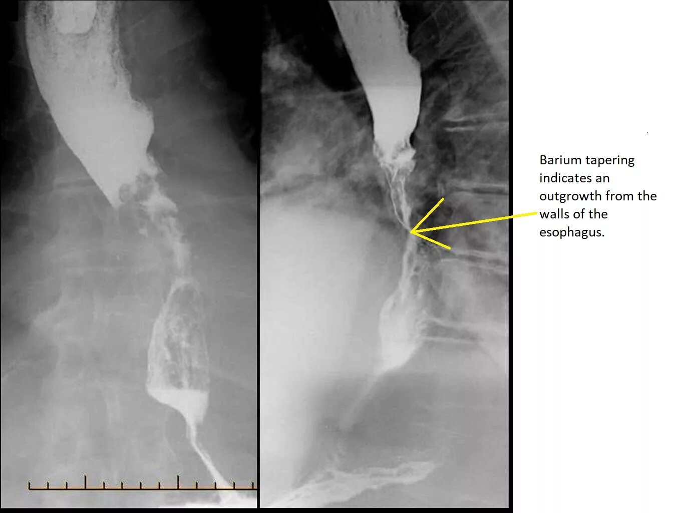 Рентген с барием пищевода и желудка подготовка. Стриктура пищевода рентген. Дисфагия пищевода рентген. Рубцовая стриктура пищевода рентген. Утолщение складок пищевода рентген.