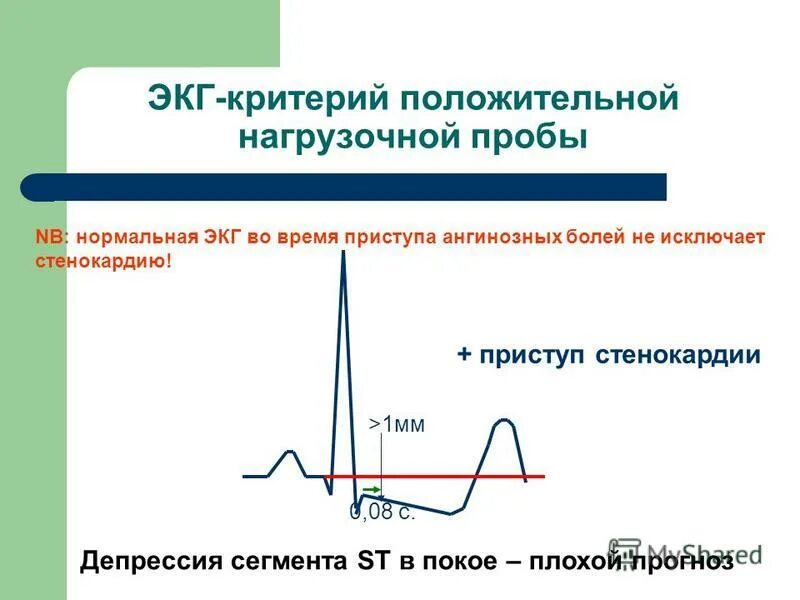 Депрессия сегмента st. Депрессия сегмента St на ЭКГ типична для. Косонисходящая депрессия St на ЭКГ. ЭКГ С депрессией сегмента St при ИБС. Косонисходящая депрессия сегмента St на ЭКГ.