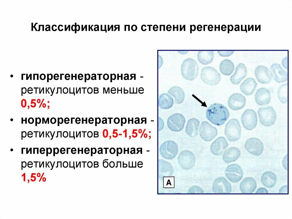 Абсолютные ретикулоциты повышены. Ретикулоциты окраска бриллиантовым крезиловым синим. Степень регенерации ретикулоцитов. Ретикулоциты 100. Ретикулоциты в периферической крови в норме.