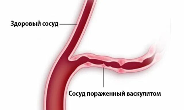 Атеросклеротические изменения сосудов. Воспаление мелких сосудов. Поражение капилляров. Поражение капилляров. Причины атеросклероза сосудов.