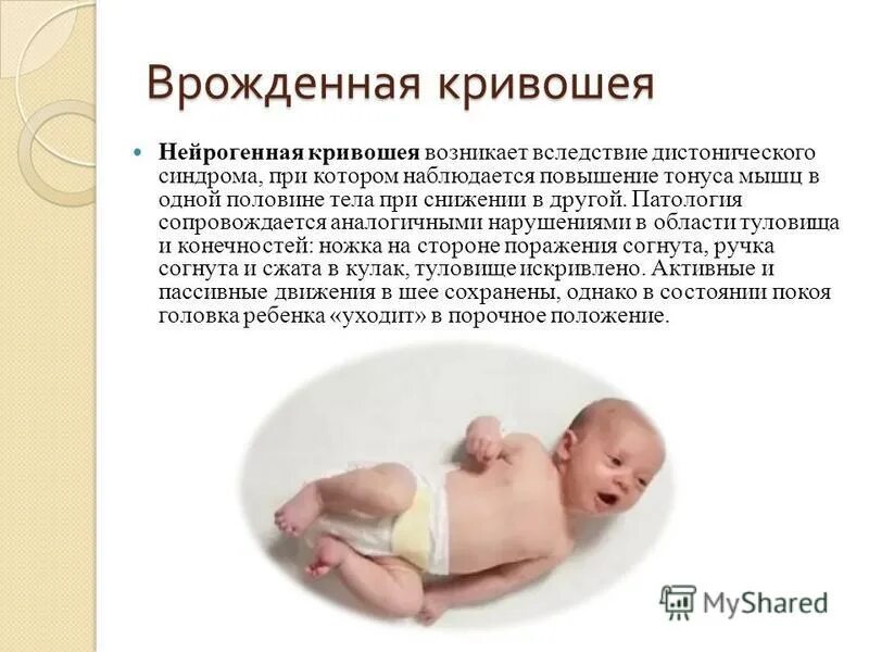 Тонус мышц языка у ребенка как определить. Гипотонус мышц у грудничков. Повышенный тонус мышц у детей. Мышечный тонус у новорожденного. Оценка мышечного тонуса у детей раннего возраста.