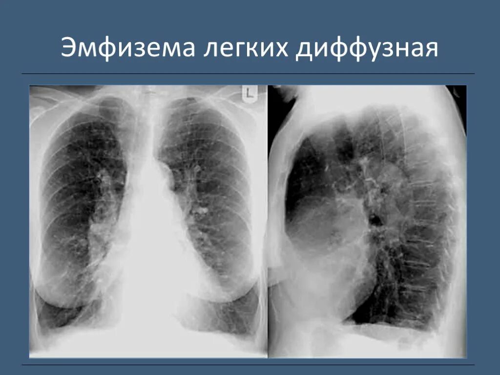 Очаговая эмфизема лёгких. Что значит легкие расширены