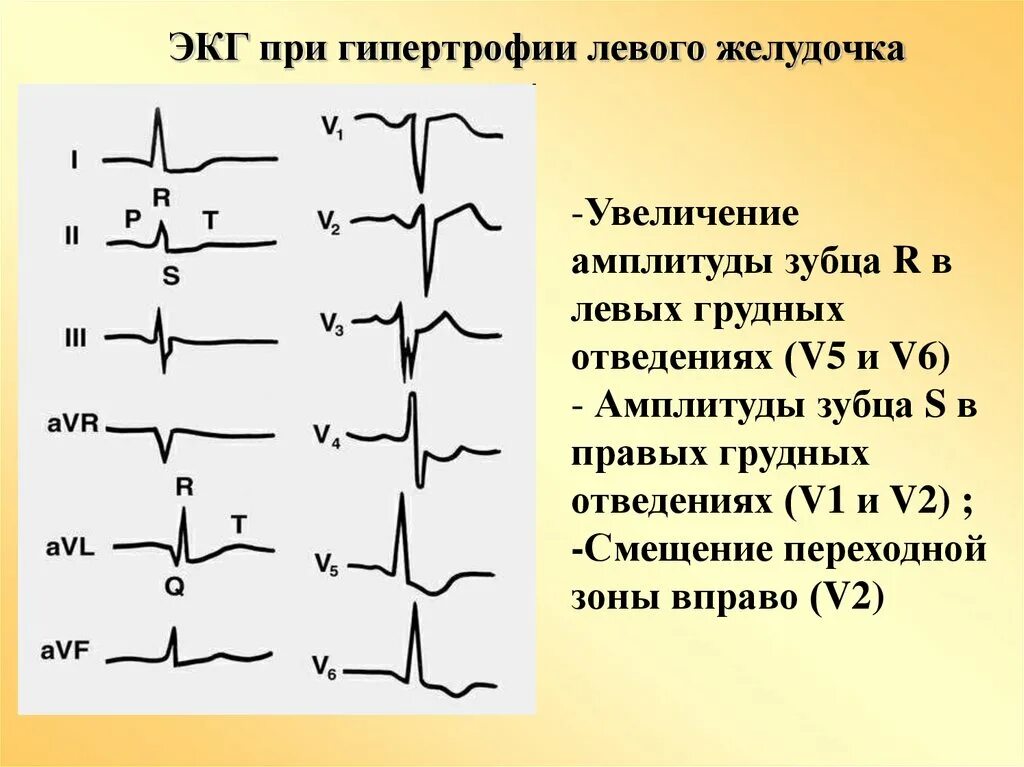 Гипертрофия левого желудочка на ЭКГ. Зубца q на ЭКГ В отведениях i, AVL, v4-v6. Гипертрофия левого желудочка ЭКГ зубец r. ЭКГ зубец s в v5-v6. Перегрузка на экг что это