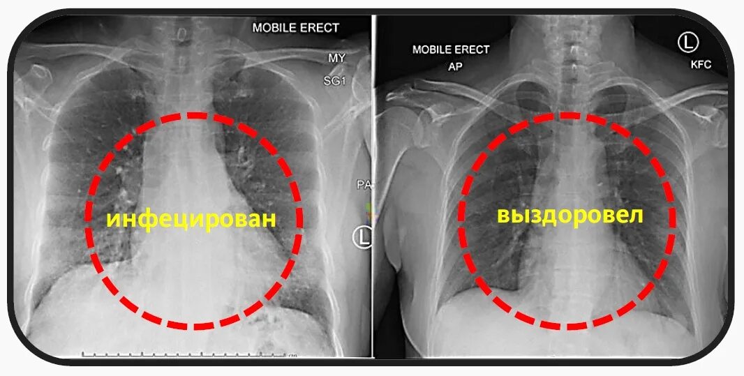 ли рентген коронавирус. снимок легких больного коронавирусом. легкие при коронавирусе снимок. коронавирус пневмония рентген. ли рентген коронавирус.