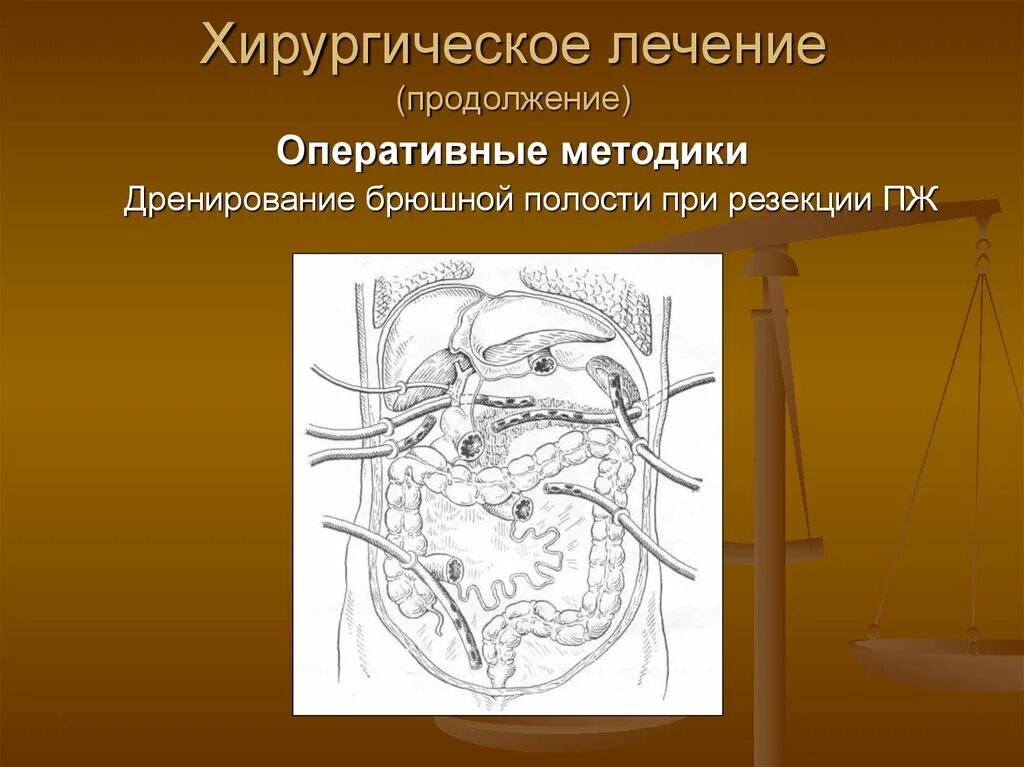 Дренирование брюшной полости панкреатит. Методы дренирования брюшной полости. Основные принципы дренирования брюшной полости. Активное дренирование брюшной полости. Абдоминальная операция что это