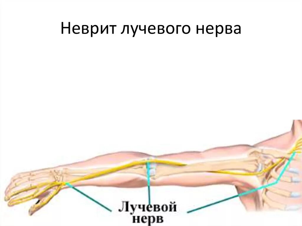 Невропатия нерва руки. Компрессионная нейропатия лучевого нерва. Посттравматическая нейропатия лучевого нерва. ЛФК невропатия лучевого нерва. Нейропатия лучевого нерва ЭНМГ.