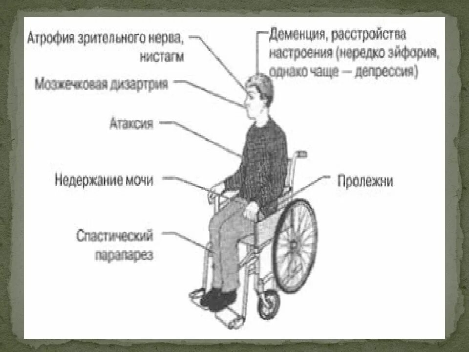 Шкала инвалидизации. Рассеянный склероз. рассеянный склероз презентация. рассеянный склероз инвалид. шкала edss при рассеянном склерозе.