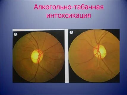 Разрыв зрительного нерва