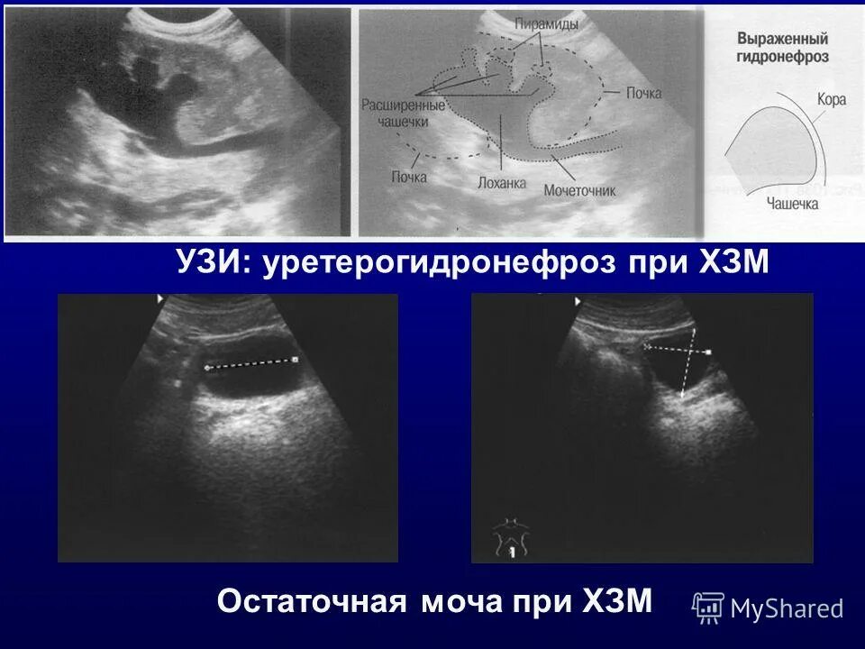 Остаток мочи у мужчин. УЗИ остаточной мочи. Остаточная моча УЗИ. УЗИ мочевого пузыря объем остаточной мочи. Расширение чашечек почки на УЗИ.