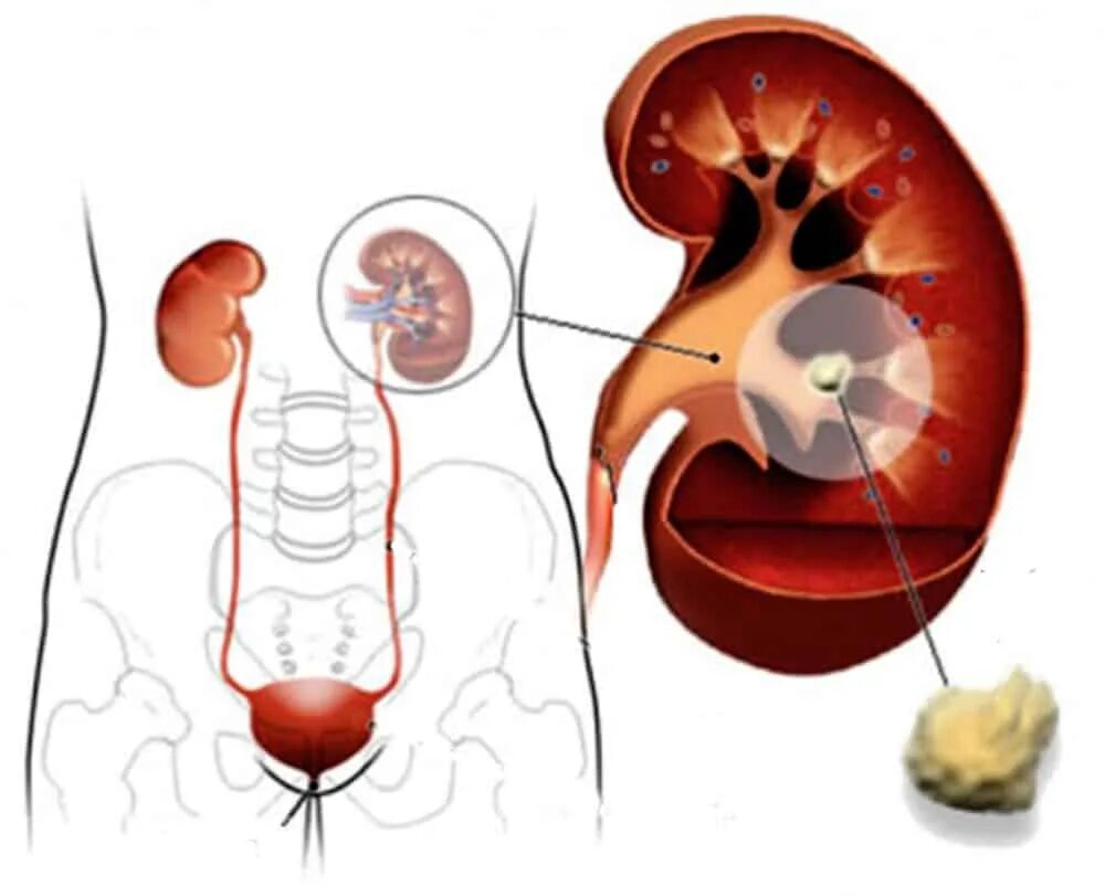 Выходит камень симптомы у мужчин. Мочекаменная болезнь камни. Мочекаменная болезнь почек.