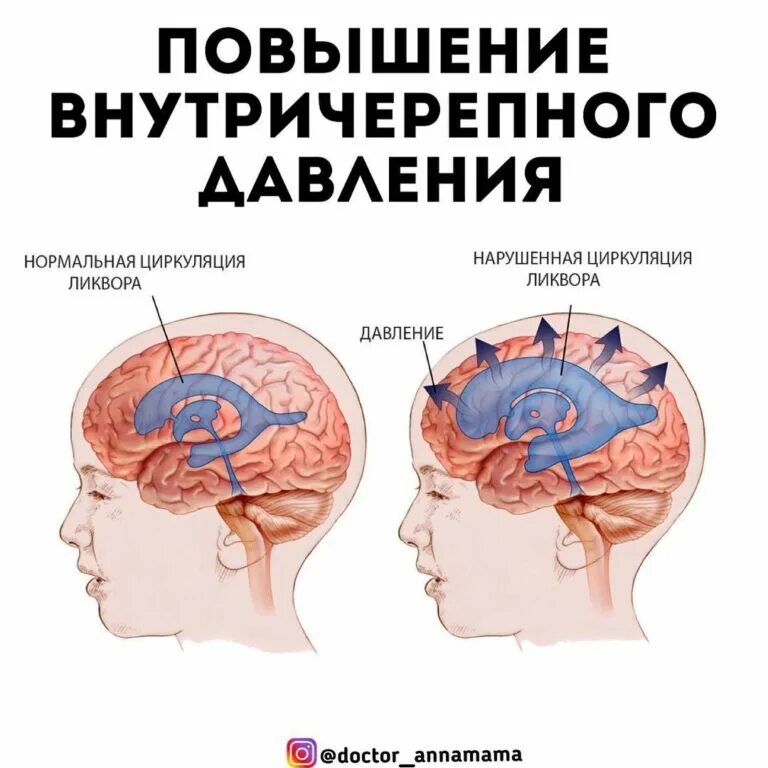 Ангиодистония сосудов головного мозга что это такое. Онмк ишемический инсульт. Гипертоническая энцефалопатия мрт. Онмк ишемический инсульт. Изменения в голове какие.