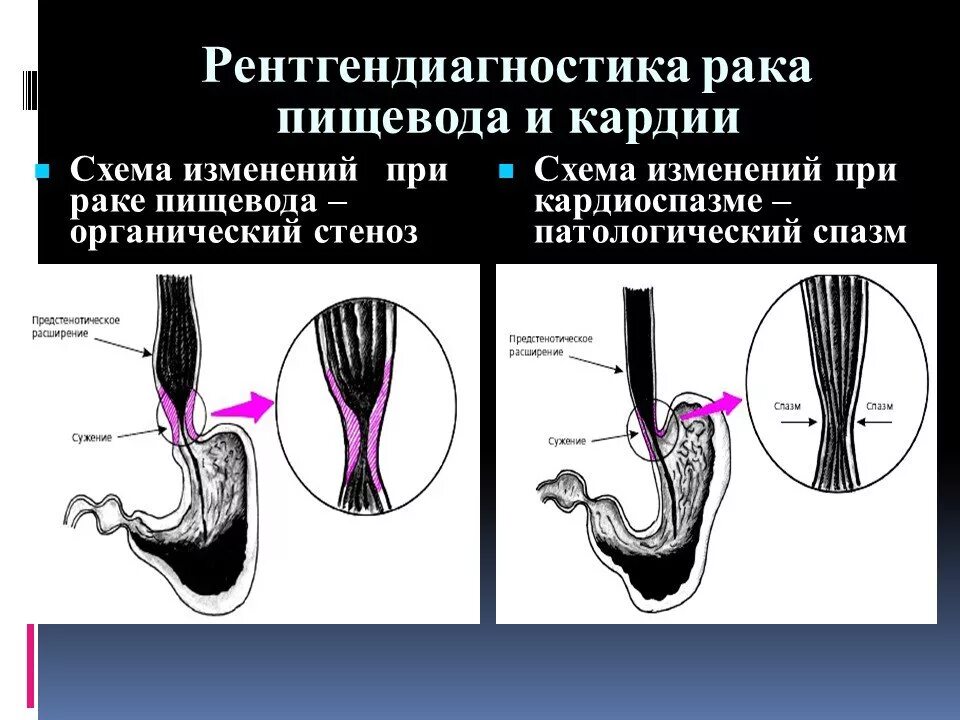 Стенд пищевода. Пищевод схема. Рентгендиагностика пищевода. Опухоли пищевода классификация.