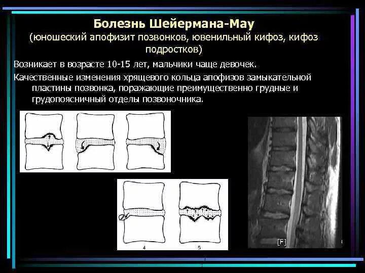 - Гиперкифоз (болезнь Шейермана-МАУ). Остеохондропатия позвонков болезнь Шейермана-МАУ. Персистирующий Апофиз позвонка кт.