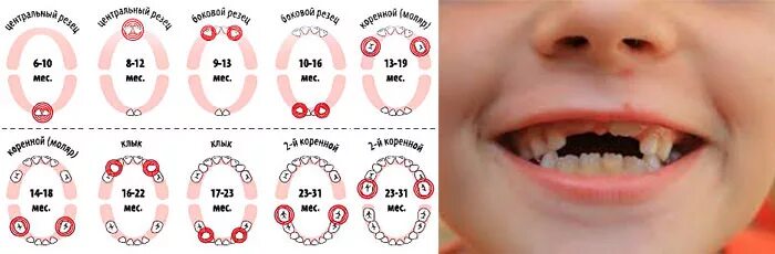 Прорезывание молочных зубов Верхние резцы. Зубы норма прорезывания молочных. Возраст прорезывания Клыков у детей. Режутся зубы у ребенка в 1,4.