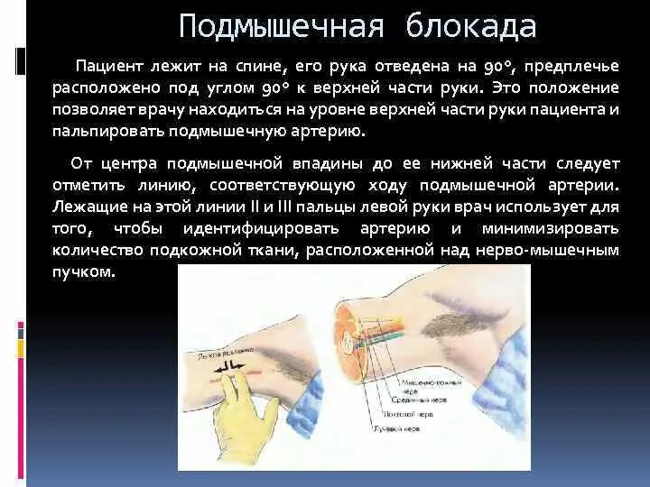 Блокада сплетения. Подмышечная проводниковая анестезия. Подмышечная блокада плечевого сплетения. Блокады верхней конечности. Блокада плечевого сплетения подмышечным доступом.