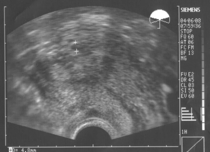 Снимок узи с двумя плодными яйцами. Узи 5-6 недель плодное яйцо 12мм. Узи беременности плодное яйцо 4 недели. Узи плодного яйца на 5 неделе беременности. Узи 3 недели беременности от зачатия.
