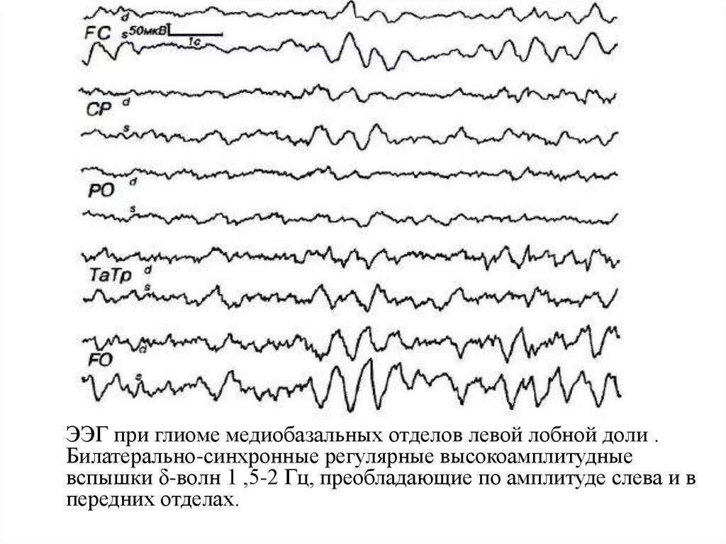 Бэа на ээг. Ээг сигнал. детектор ээг схема. ээг при лунатизме.