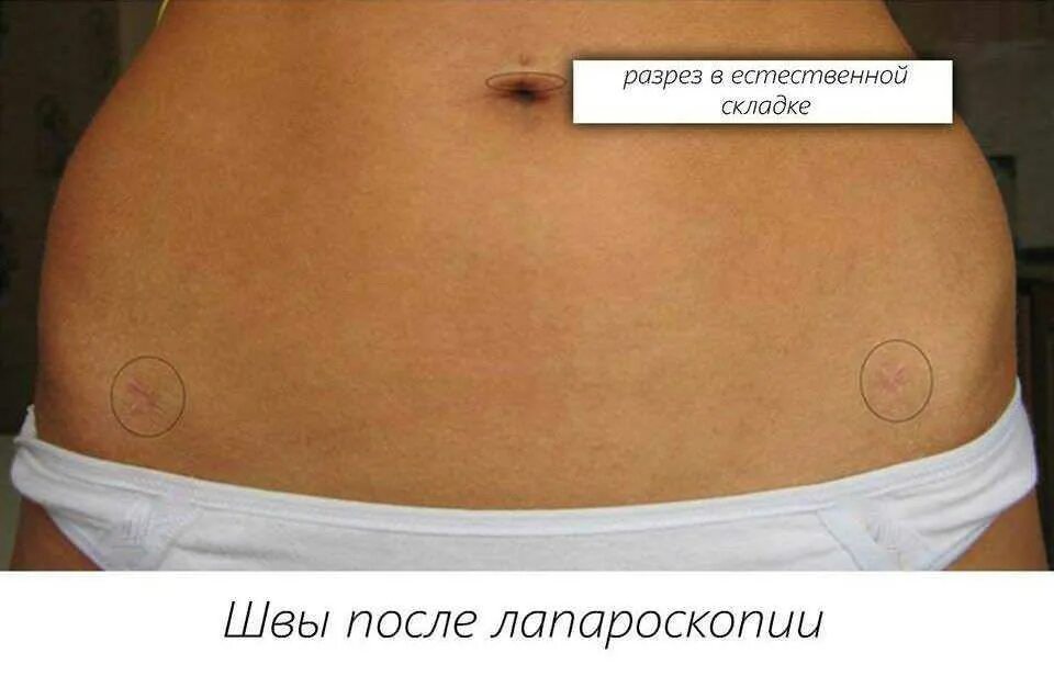После аппендицита сколько нельзя поднимать