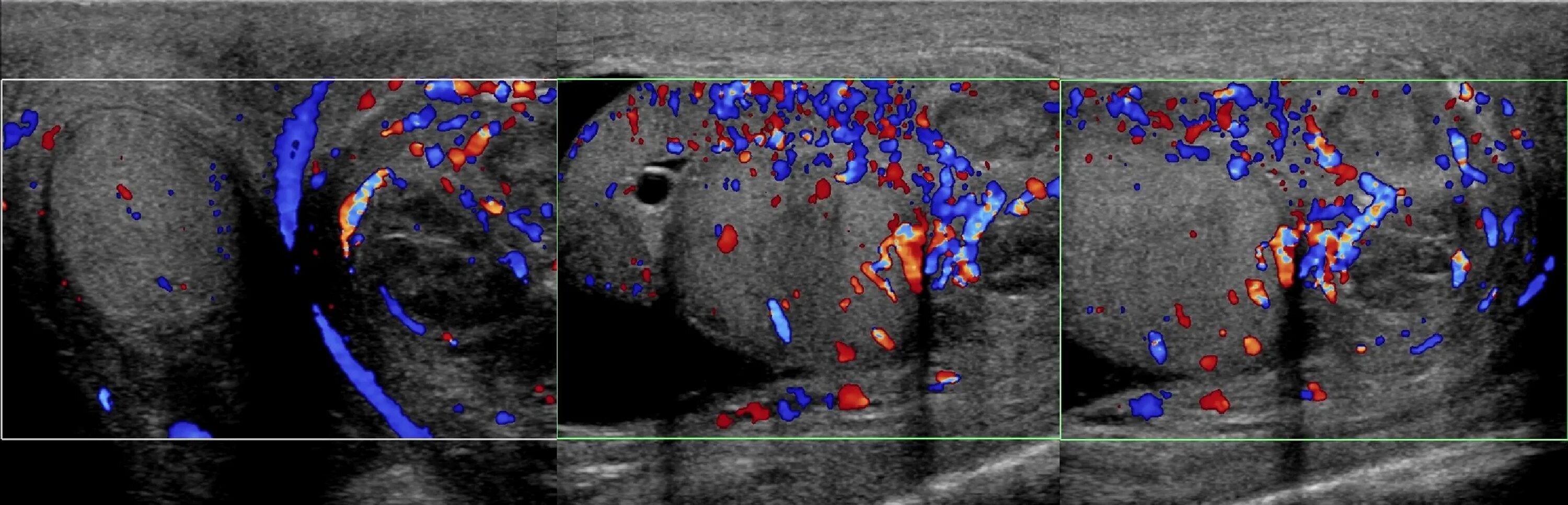 Усиленная васкуляризация. Семенной канатик на УЗИ мошонки. Перекрут яичка УЗИ диагностика. Воспаление семенного канатика на УЗИ.