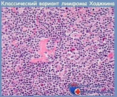 Нодулярная лимфома ходжкина с лимфоидным