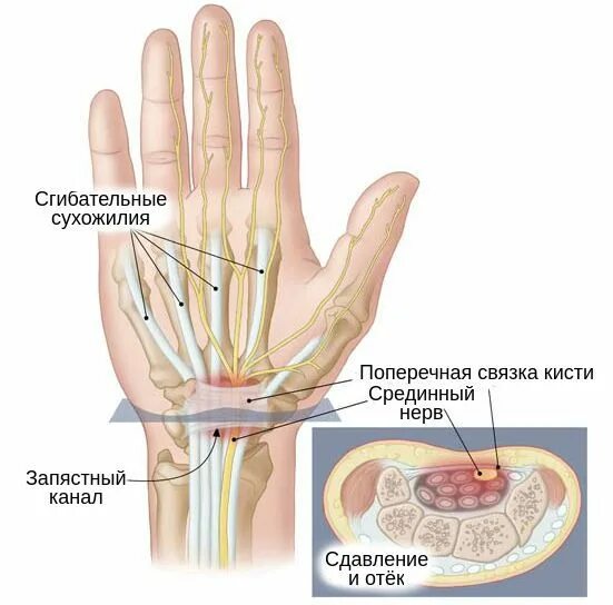 Защемление нерва в запястье. Синдром карпального канала срединного нерва. синдром запястного канала анатомия. карпальный канал топографическая анатомия. туннельный синдром лучевого нерва симптомы.