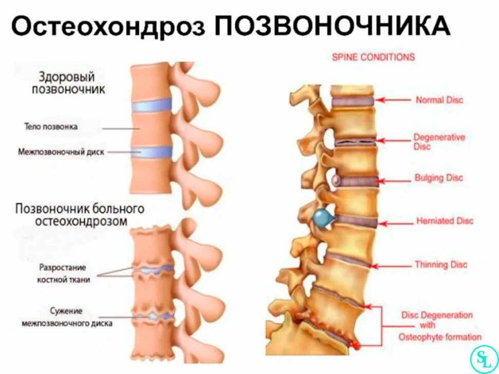 Синдромы остеохондроза поясничного отдела. Остеохондроз. Остеохондроз позвоночника. Позвоночник позвонки остеохондроз. Остеохондроз грудного отдела позвоночника.