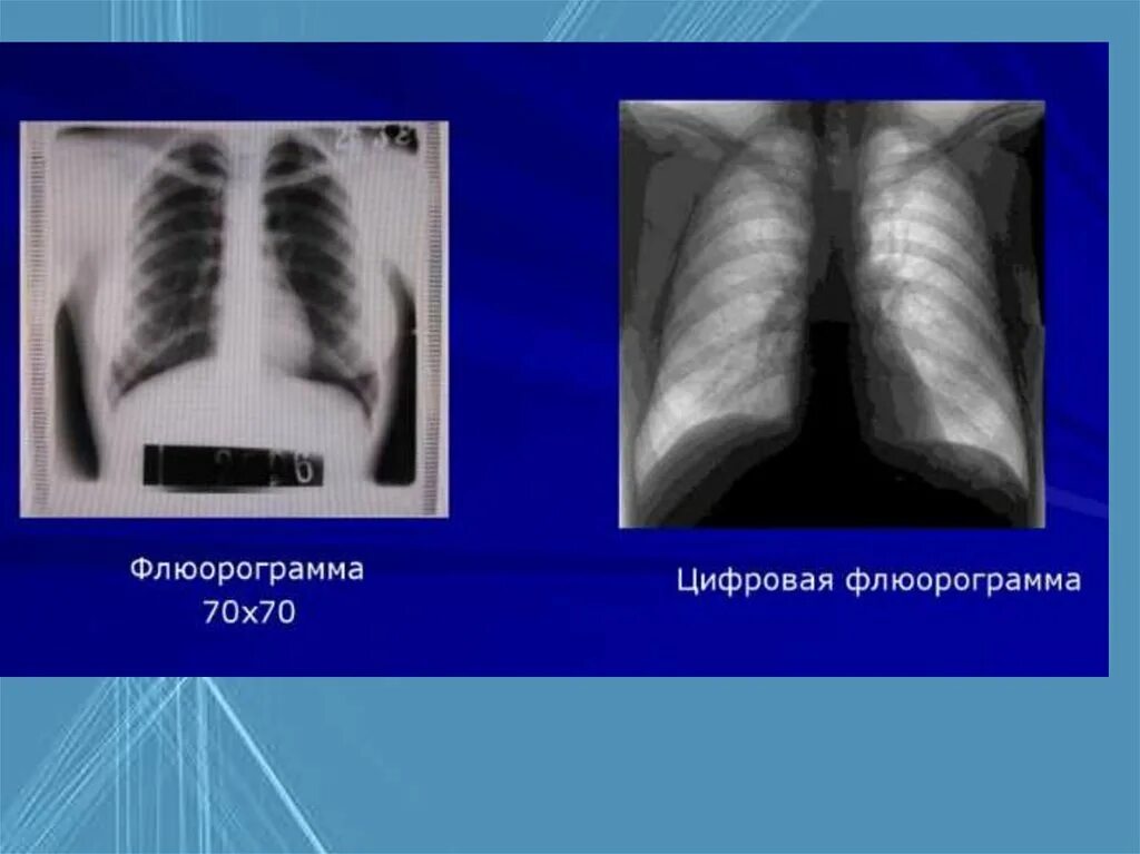 Рентгеноскопия и рентгенография легких. Флюорография и рентгенография. Рентгеноскопия флюорография. После флюорография можно можно кт делать