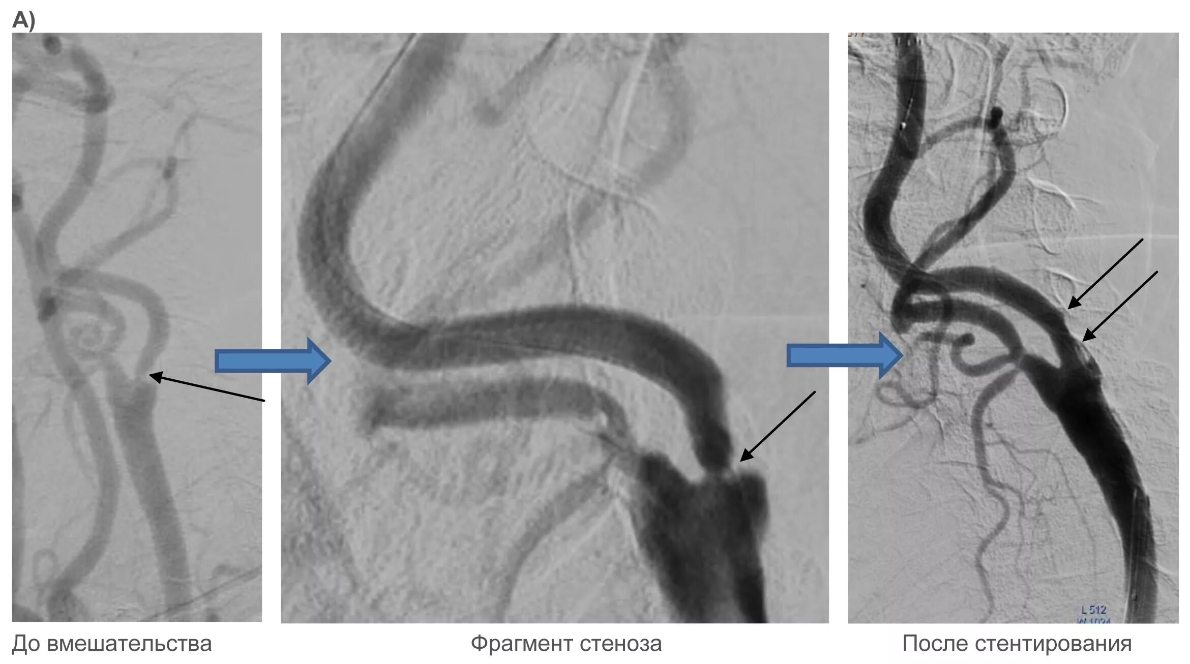Изгиб вса. Септальный стеноз подключичной артерии. Стентирование коронарных артерий. Стеноз коронарных артерий.