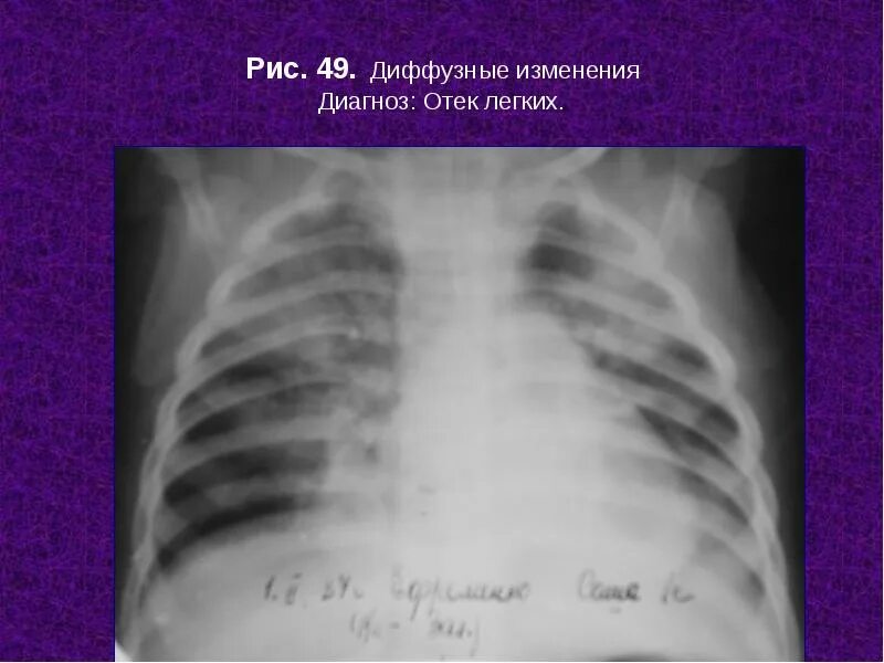 Диагноз диффузное изменение. Диффузные изменения в легких. легкие диффузные изменения. диффузные изменения лег. диагноз отёк легких.