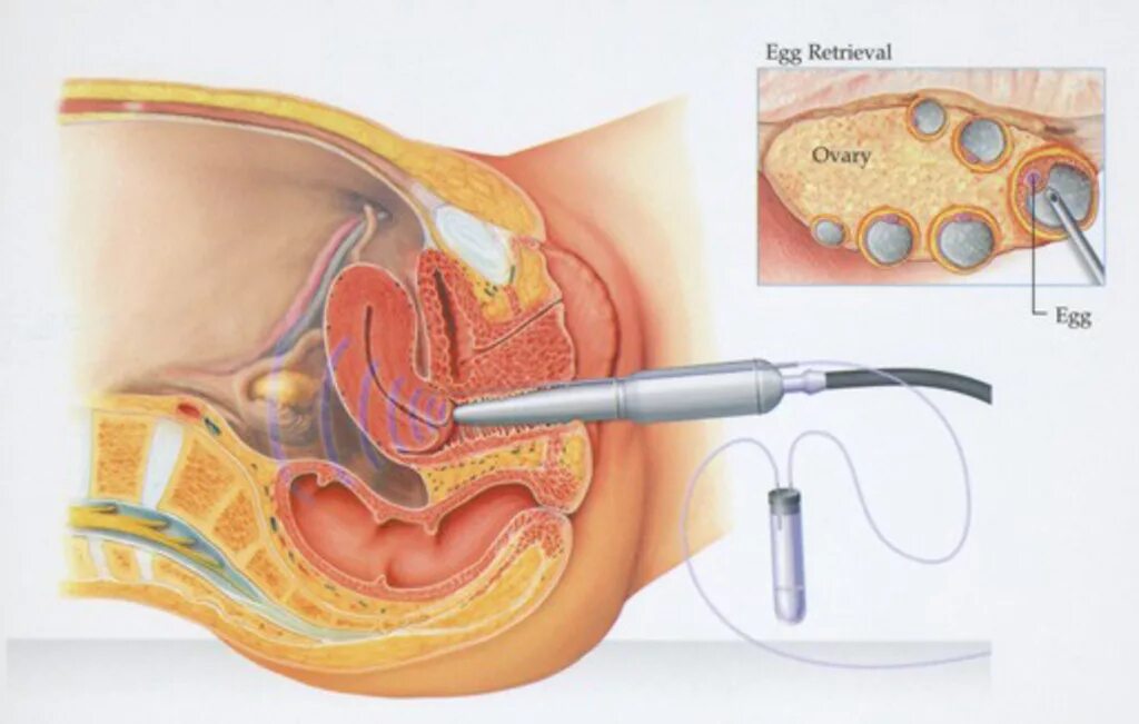 Боли после пункции фолликулов. Пункция фолликулов яичника. Пункция фолликулов яичника экстракорпоральное оплодотворение. Пункция забора яйцеклетки. Трансвагинальная пункция фолликулов.