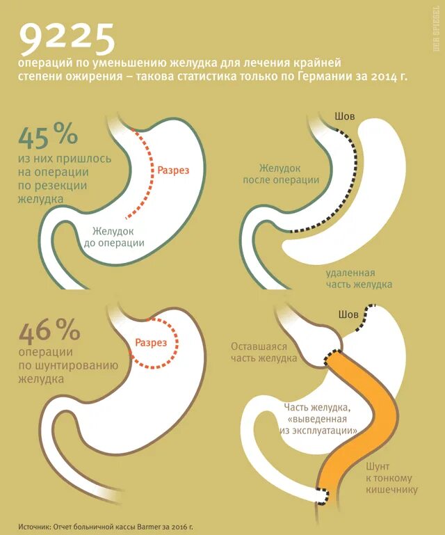 После операции по уменьшению желудка. Операция по уменьшению желудка. Уменьшение размера желудка. Виды операций по уменьшению желудка.