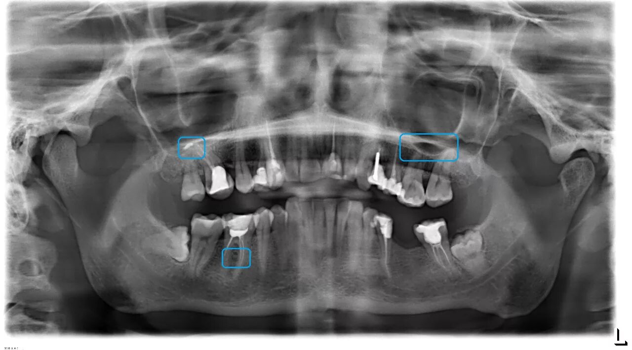 Снимок зубов видное. Панорамный снимок зубов. Снимки. Снимок панорамный снимок. Панорамный снимок суставов.