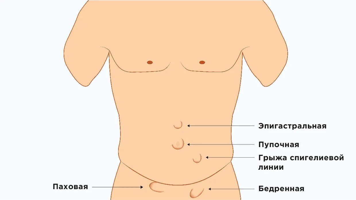 Эпигастральная вентральная грыжа. Локализация грыж живота. Грыжа белой линии живота.