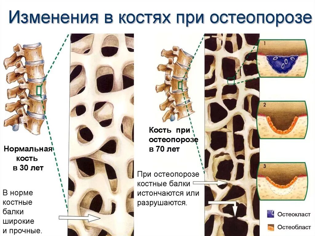 Структурные изменения костей. Диффузный сенильный остеопороз. Остеопороз 4 степени позвоночника. Костная ткань в норме и остеопороз. Нормальная кость и кость при остеопорозе.