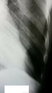 Перелом 9 ребра