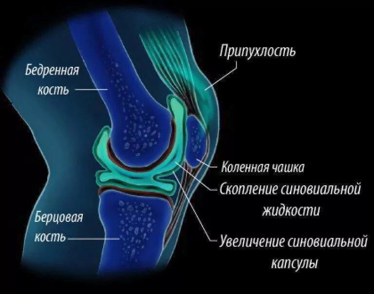 Как устроено колено. Коленный сустав анатомия строение. Коленный сустав строение коленный сустав строение. Синовит синовиальная оболочка. Воспаление синовиальной оболочки коленного сустава.