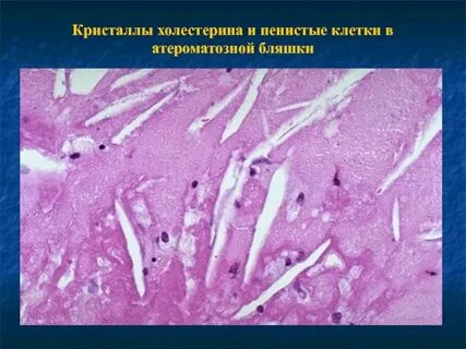 Кальциноз стенок
