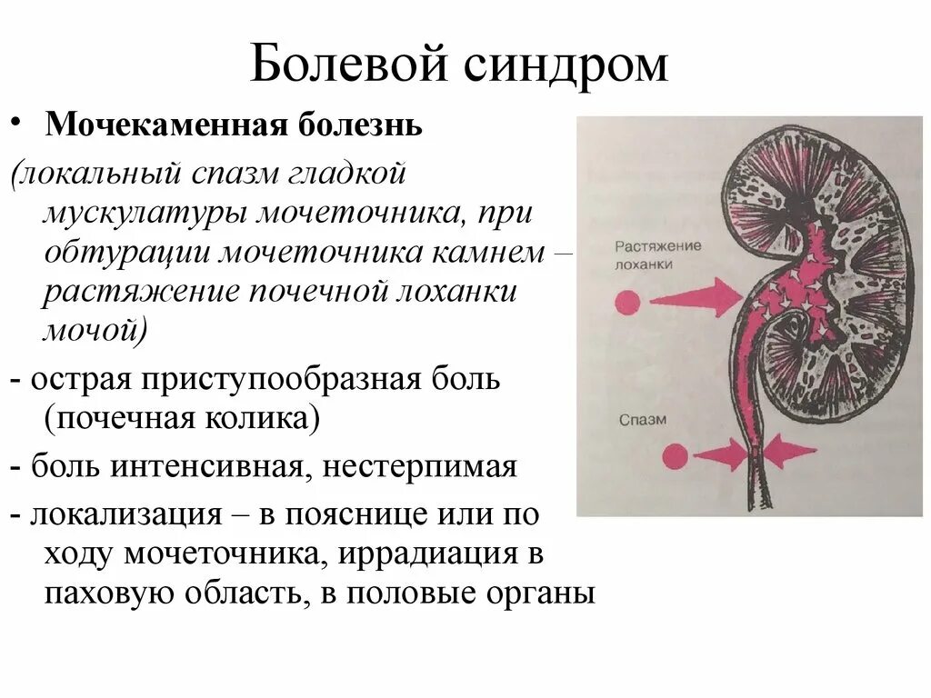 Основные клинические проявления мочекаменной болезни. Спастические сокращения мочеточника. Мочекаменная болезнь болевой синдром.