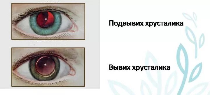 Вывих хрусталика. Синдром марфана эктопия хрусталика. синдром марфана подвывих хрусталика.
