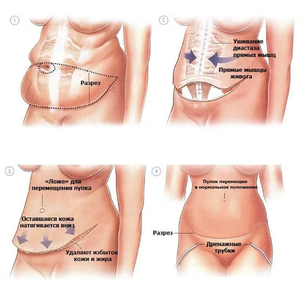 Схема проведения кесарева сечения. Диастаз прямых мышц живота. Схема абдоминопластики. Пластика живота после кесарева сечения.